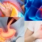 Reflu Hastalığı: Belirtileri, Nedenleri ve Tedavisi